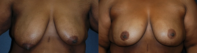 Case 8320 - Woman treated with Breast Reduction, Breast Lift