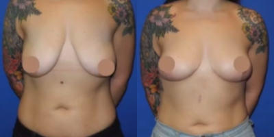Case 8334 - Woman treated with Breast Lift