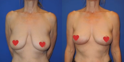Case 8335 - Woman treated with Breast Lift
