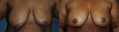 Case 8336 - Woman treated with Breast Reduction, Breast Lift