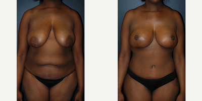 Case 8337 - Woman treated with Breast Reduction, Breast Lift