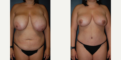 Case 8338 - Woman treated with Breast Reduction, Breast Lift