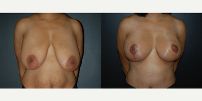 Case 8339 - Woman treated with Breast Lift, Breast Reduction