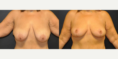 Case 8341 - Woman treated with Breast Lift, Breast Reduction