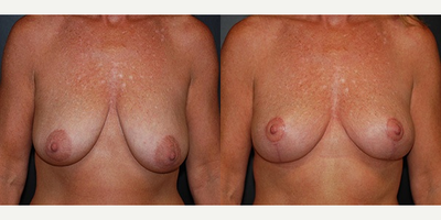 Case 8343 - Woman treated with Breast Lift, Breast Reduction