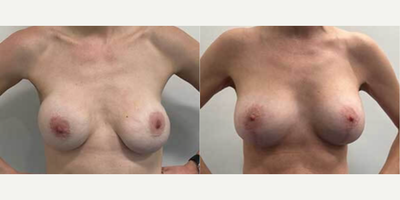 Case 8348 - Woman treated with Breast Lift