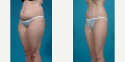 Case 835 - 25-34 year old woman treated with Abdominal Etching, Diastasis Recti Repair, Drainless Tummy Tuck, Liposculpture, Liposuction, M