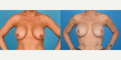 Case 8355 - 35-44 year old woman treated with Breast Augmentation, Breast Implant Removal, Breast Implant Revision, Breast Implants, Breast 