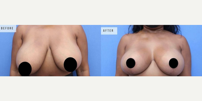 Case 8356 - Woman treated with Breast Lift, Breast Reduction