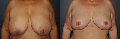 Case 8358 - Woman treated with Breast Lift, Breast Reduction