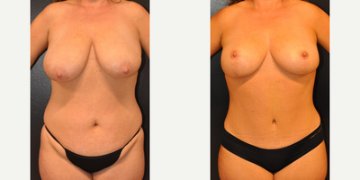 Case 8359 - Woman treated with Breast Lift, Breast Reduction
