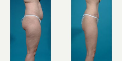 Case 836 - 25-34 year old woman treated with Abdominal Etching, Diastasis Recti Repair, Drainless Tummy Tuck, Liposculpture, Liposuction, M