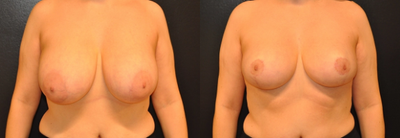 Case 8360 - Woman treated with Breast Lift, Breast Reduction