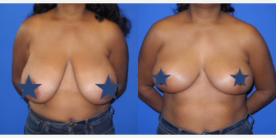 Case 8362 - Woman treated with Breast Lift, Breast Reduction, Areola Reduction Surgery