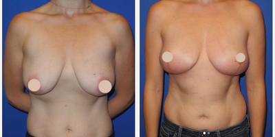 Case 8363 - Woman treated with Breast Lift