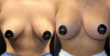 Case 8364 - Woman treated with Breast Lift