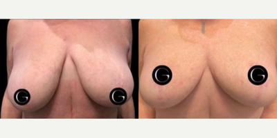 Case 8365 - Woman treated with Breast Lift