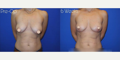 Case 8366 - Woman treated with Breast Lift
