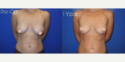 Case 8367 - Woman treated with Breast Lift