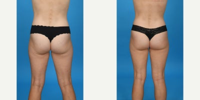 Case 837 - 35-44 year old woman treated with Abdominal Etching, Diastasis Recti Repair, Drainless Tummy Tuck, Liposculpture, Liposuction, M