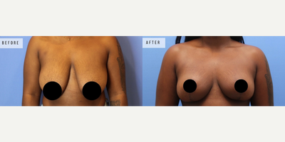 Case 8372 - Woman treated with Breast Lift