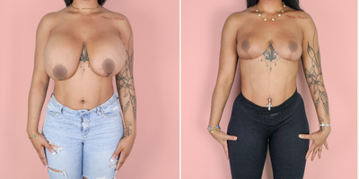 Case 8378 - 25-34 year old woman treated with Breast Reduction, Breast Lift, Breast Implant Removal, Capsular Contracture Treatment