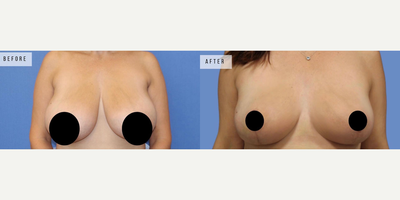 Case 8379 - Woman treated with Breast Lift
