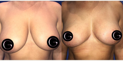 Case 8386 - Woman treated with Breast Lift