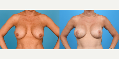 Case 8388 - 25-34 year old woman treated with Breast Augmentation, Breast Implants, Breast Implant Revision, Breast Lift, Breast Lift with I