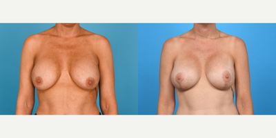 Case 8389 - 25-34 year old woman treated with Breast Augmentation, Breast Implants, Breast Implant Revision, Breast Lift, Breast Lift with I