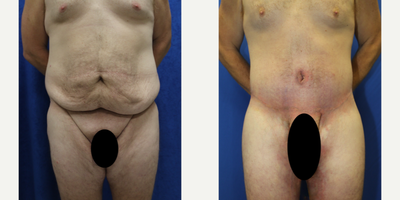 Case: 8391 - before and after photo of 25-34 year old man treated with Body Lift by J. Timothy Katzen, MD, FACS