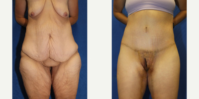 Case: 8392 - before and after photo of 45-54 year old woman treated with Body Lift by J. Timothy Katzen, MD, FACS