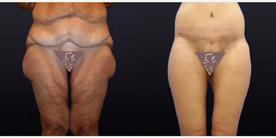 Case: 8393 - before and after photo of 45-54 year old woman treated with Body Lift by J. Timothy Katzen, MD, FACS