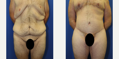 Case: 8394 - before and after photo of 25-34 year old man treated with Body Lift by J. Timothy Katzen, MD, FACS