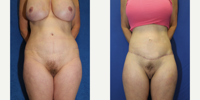 Case: 8395 - before and after photo of 55-64 year old woman treated with Body Lift by J. Timothy Katzen, MD, FACS