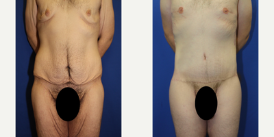 Case: 8396 - before and after photo of 35-44 year old man treated with Body Lift by J. Timothy Katzen, MD, FACS