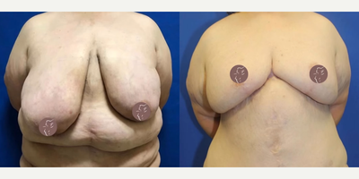 Case: 8397 - before and after photo of 45-54 year old woman treated with Body Lift, Breast Augmentation by J. Timothy Katzen, MD, FACS