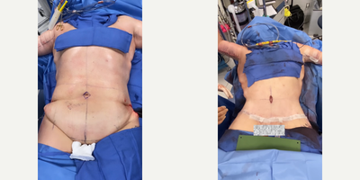 Case: 8398 - before and after photo of 35-44 year old woman treated with Body Lift by J. Timothy Katzen, MD, FACS