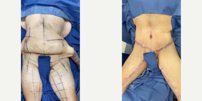 Case: 8399 - before and after photo of 25-34 year old woman treated with Body Lift by J. Timothy Katzen, MD, FACS