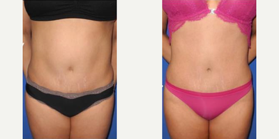 Case 84 - Woman treated with Tummy Tuck