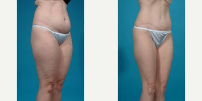 Case 840 - 25-34 year old woman treated with Abdominal Etching, Diastasis Recti Repair, Drainless Tummy Tuck, Liposculpture, Liposuction, M