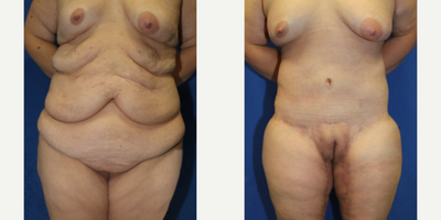 Case 8400 - 25-34 year old woman treated with Body Lift