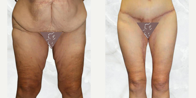 Case 8401 - 35-44 year old woman treated with Body Lift