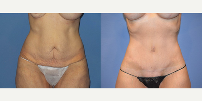 Case 8402 - 43 year old woman treated with Body Lift