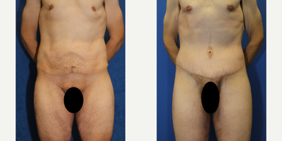 Case 8403 - 45-54 year old man treated with Body Lift