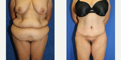 Case 8404 - 45-54 year old woman treated with Body Lift