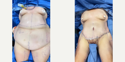 Case 8405 - 45-54 year old woman treated with Body Lift