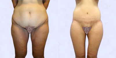 Case 8406 - 35-44 year old woman treated with Body Lift, Thigh Lift