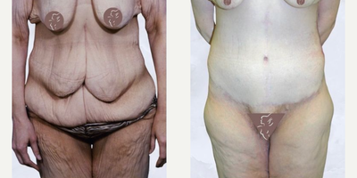 Case 8407 - 35-44 year old woman treated with Body Lift