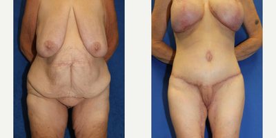 Case 8408 - 55-64 year old woman treated with Body Lift